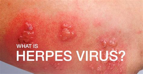 infections that are similar to herpes